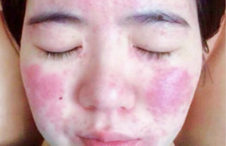 珍妮肤护肤小技巧：激素脸如何护理？