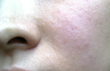 珍妮肤护肤小技巧：脸部皮肤过敏如何护理？